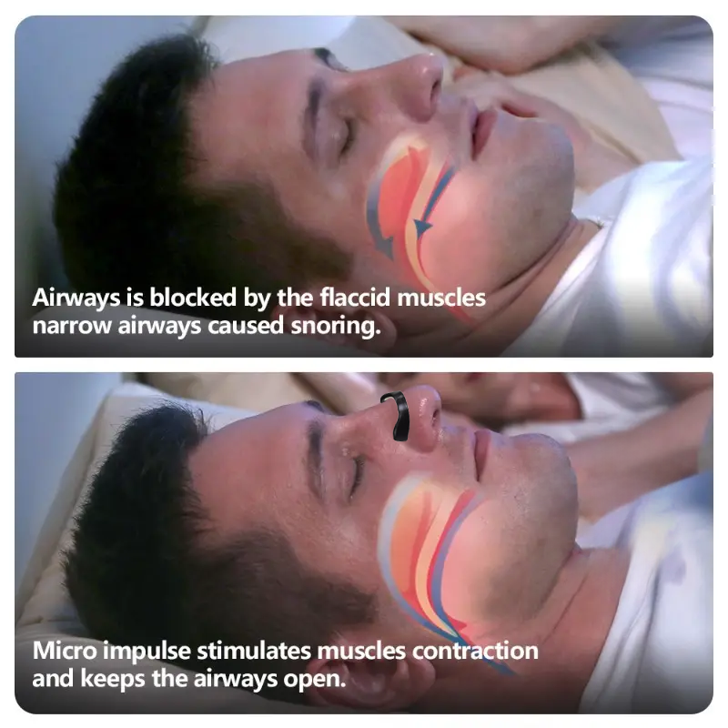nasal dilator for snoring - runny& clogged nose |better breathing|better sleep