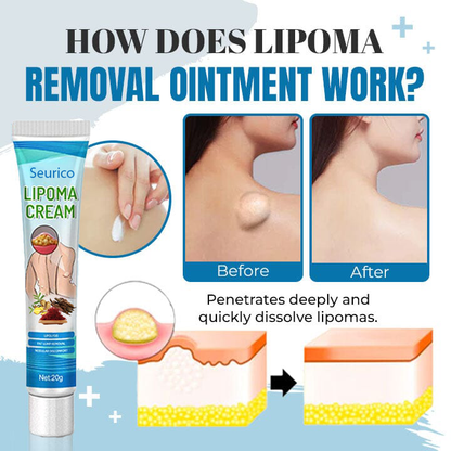 Seurico™ Lipoma Removal Ointment