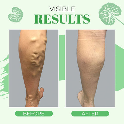 VeinoPro Varicose-Veins Treatment Soap