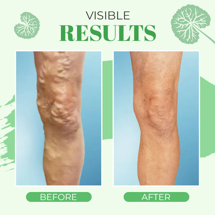 VeinoPro Varicose-Veins Treatment Soap