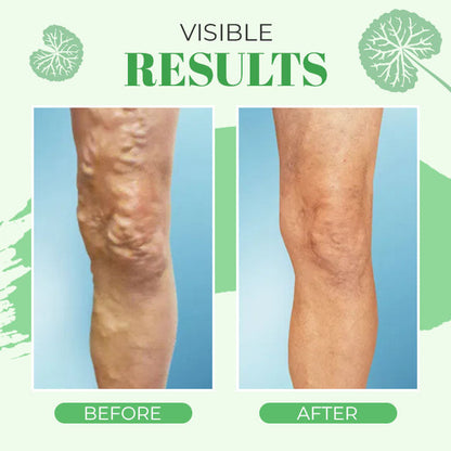 VeinoPro Varicose-Veins Treatment Soap