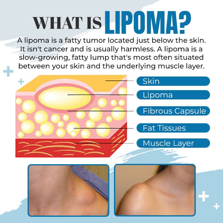 Seurico™ Lipoma Removal Ointment