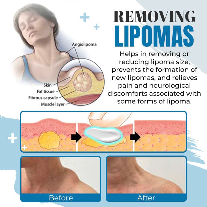 Seurico™ Lipoma Removal Ointment