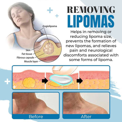 Seurico™ Lipoma Removal Ointment