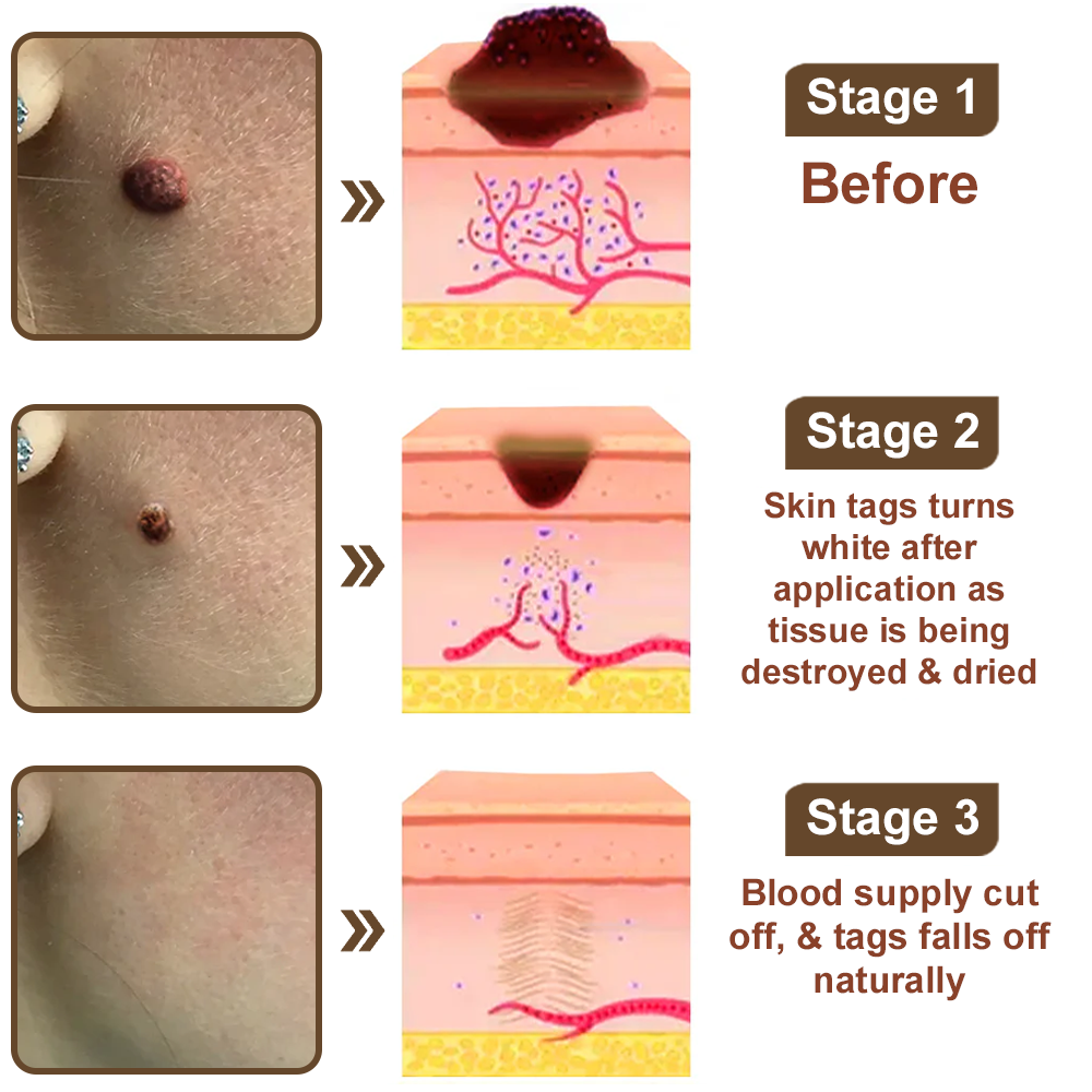 Black Rice Skin Repair Essence Cream 👨‍⚕️ FDA Certified (Removes warts and skin growths, improves keratin buildup and seborrheic dermatitis, follicular keratosis, age spots, and bruising)