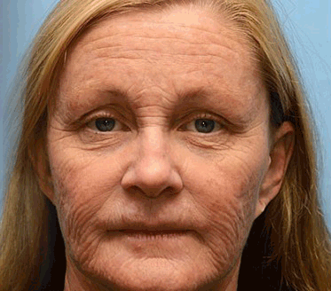 (Made and Shipped from USA) 🧑‍⚕️NEGUSY® Botox Bee Venom Wrinkle Removal Cream