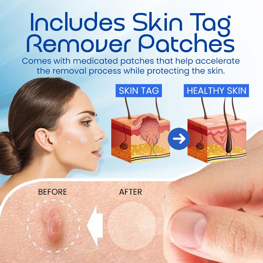 Skin Tag Remover