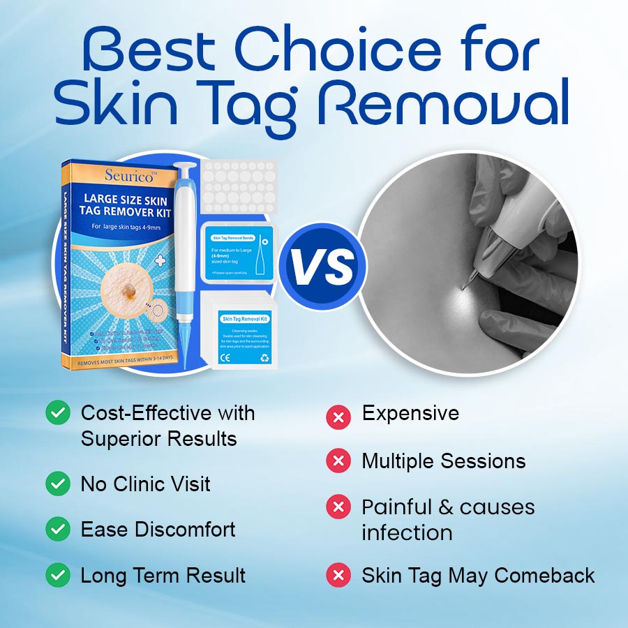 Skin Tag Remover